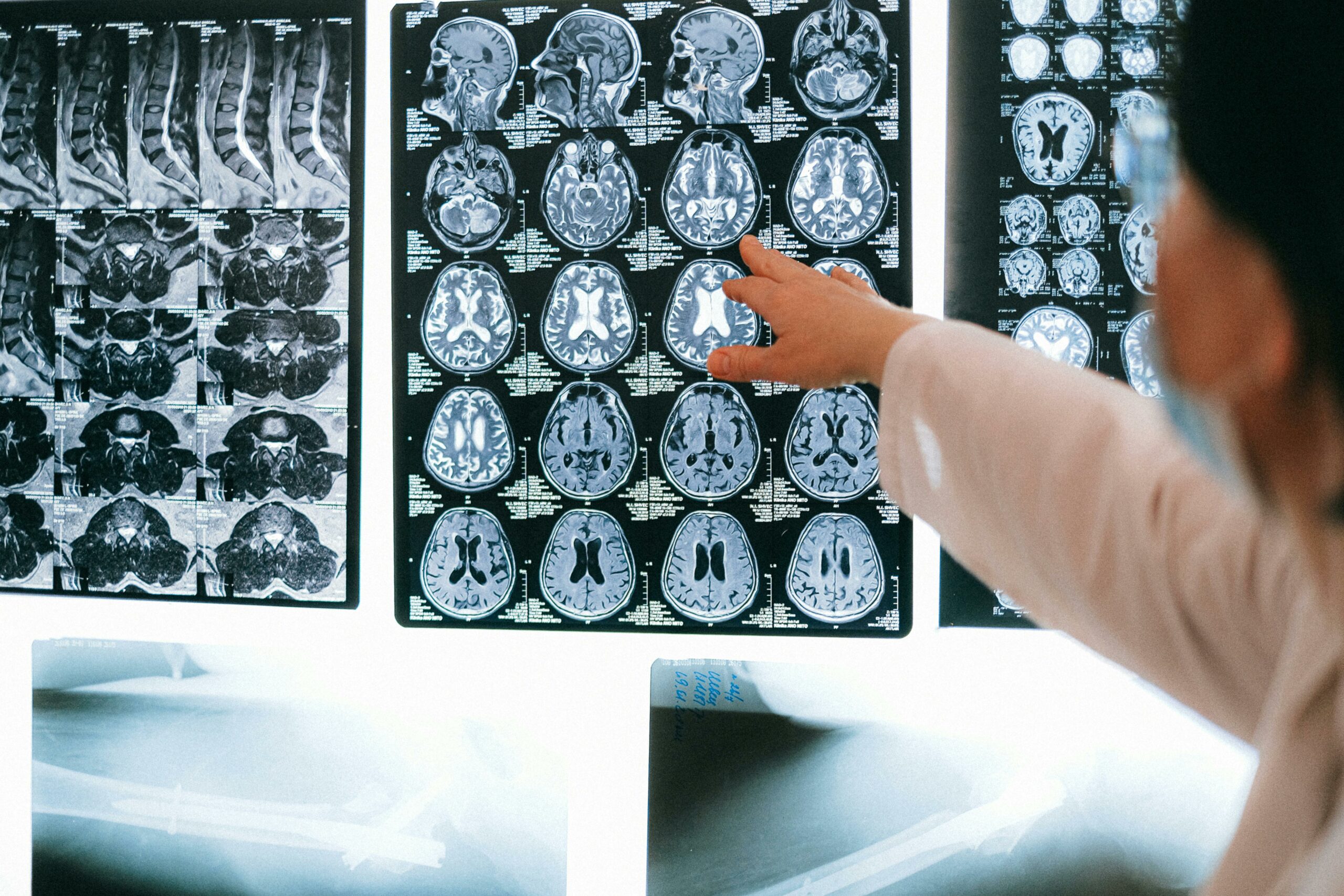 2025 HDBuzz 상: MR-‘왜’ 나는 이렇게 느낄까? MRI가 HD 환자들이 때때로 자신의 증상을 알아차리지 못하는 이유를 이해하는 데 어떻게 도움이 되는지